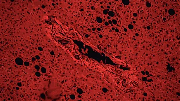 Fatty liver tissue degeneration