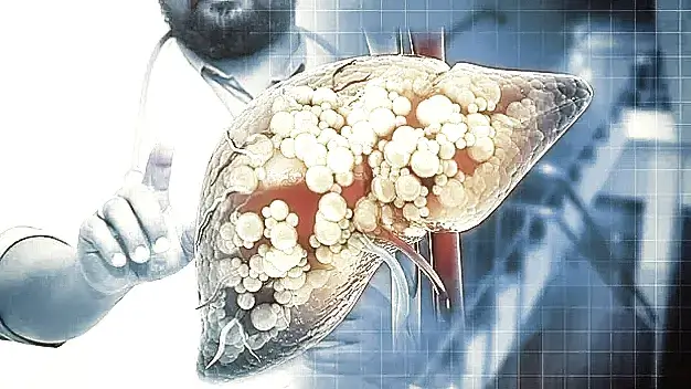 Diseased liver