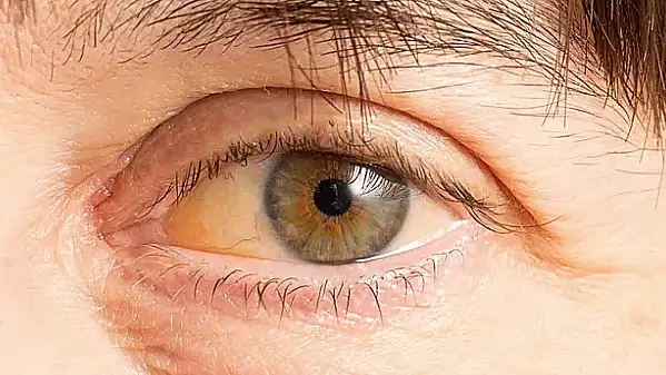 A jaundice eye